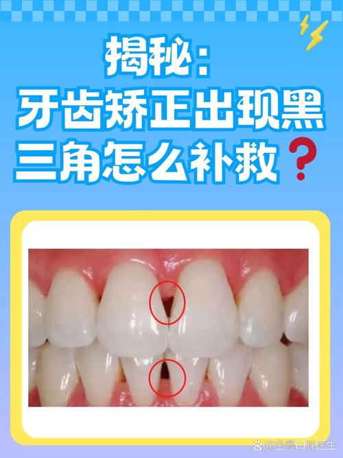 正畸根控 黑三角-图1