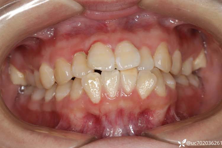 安氏三类正畸拔牙-图2