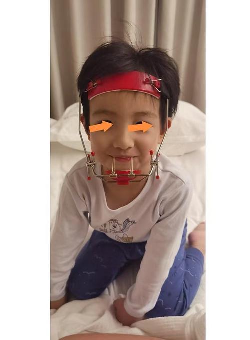 直丝弓正畸矫正器-图2