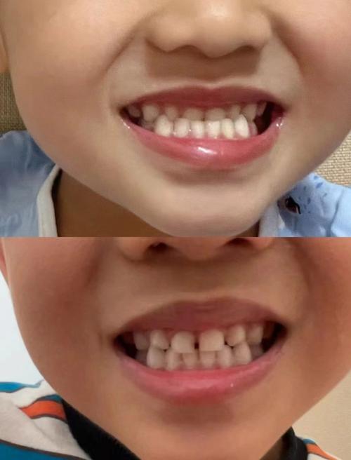 地包天正畸拔上牙-图1