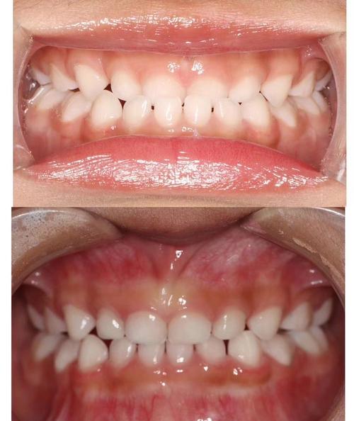 地包天正畸拔上牙-图2