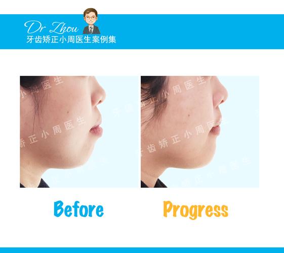 北京大学海外正畸-图3