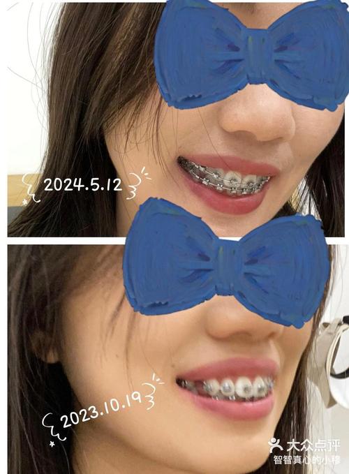 下牙正畸拔一颗牙-图1