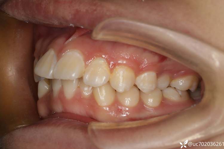 拔虎牙正畸只拔一颗效果好吗?脸型会变吗?-图2 拔虎牙正畸只拔一颗效果好吗?脸型会变吗?-图2