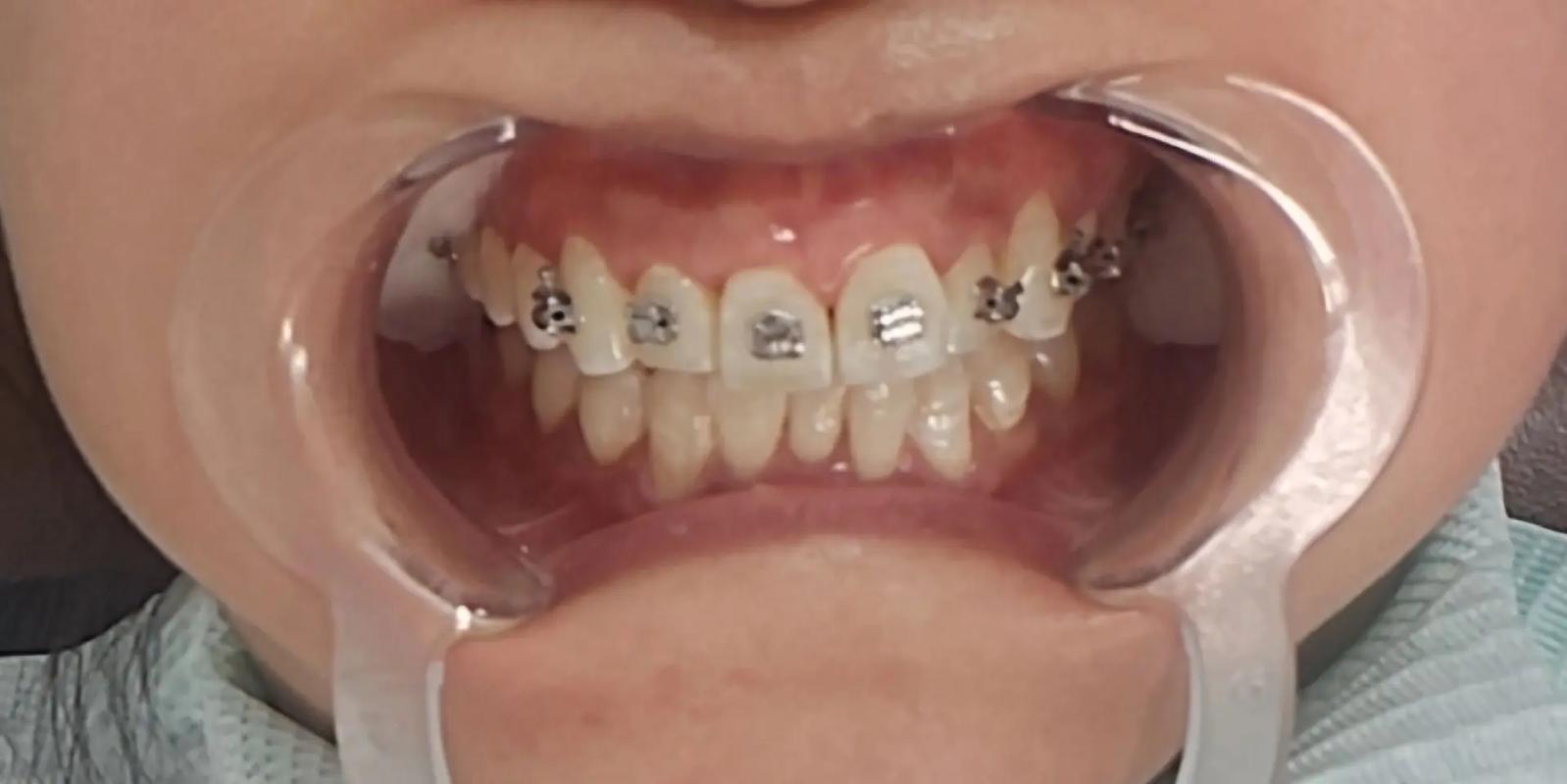 正畸弓丝有圆形的吗？这种弓丝在矫正中有什么用？-图3