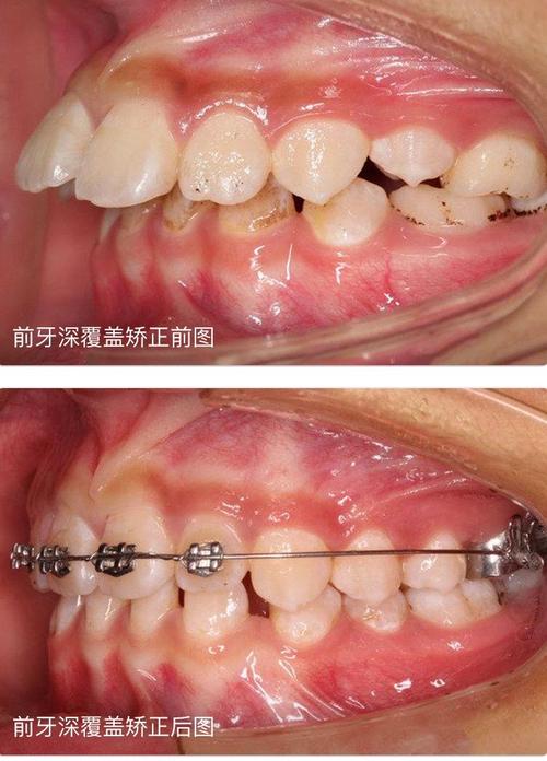 低角型深覆合正畸-图1