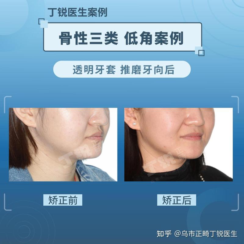 口腔正畸骨性三类-图2