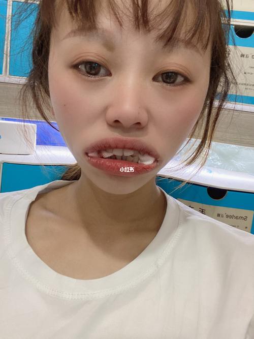 正畸一定要拔上6号牙吗？-图3