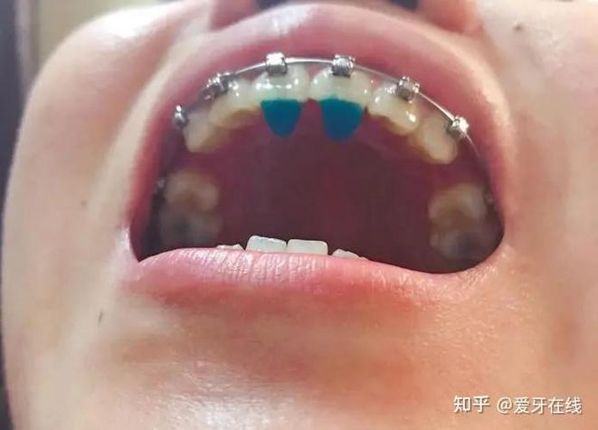 正畸平导3d演示-图2