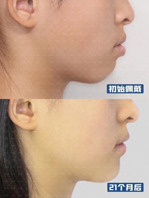 下颌牙正畸后唇倾-图2