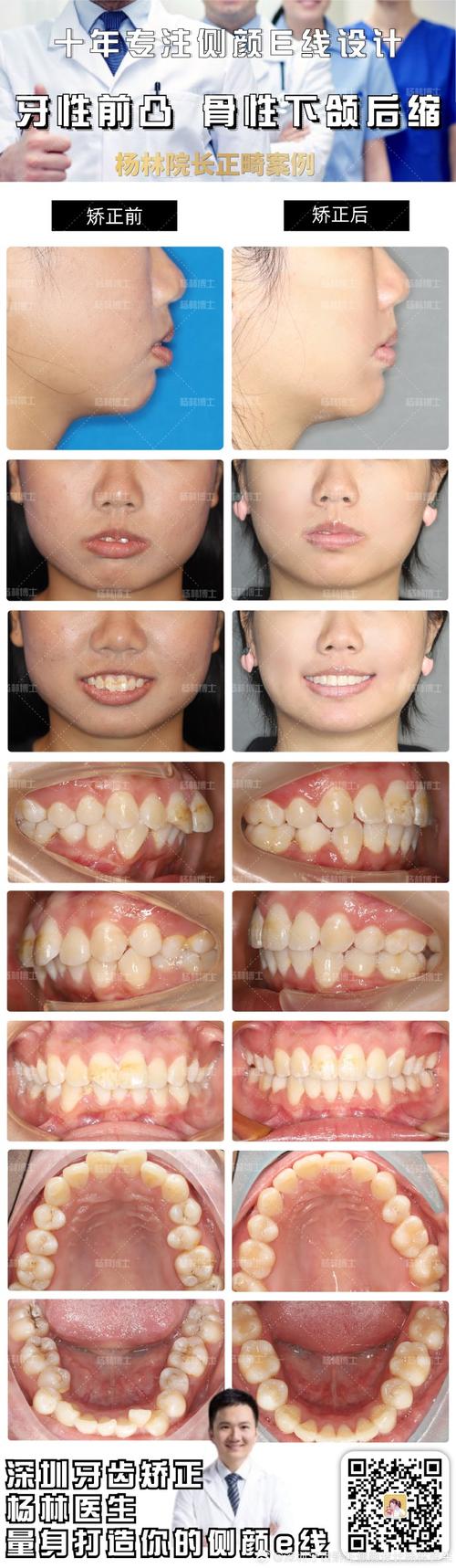 下颌牙正畸后唇倾-图3