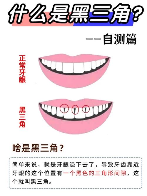 正畸什么是黑三角-图1