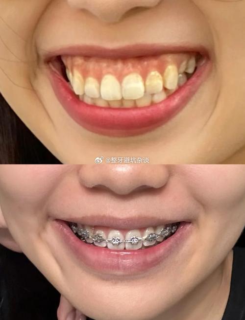 正畸过程中露龈笑-图2 正畸过程中露龈笑-图2