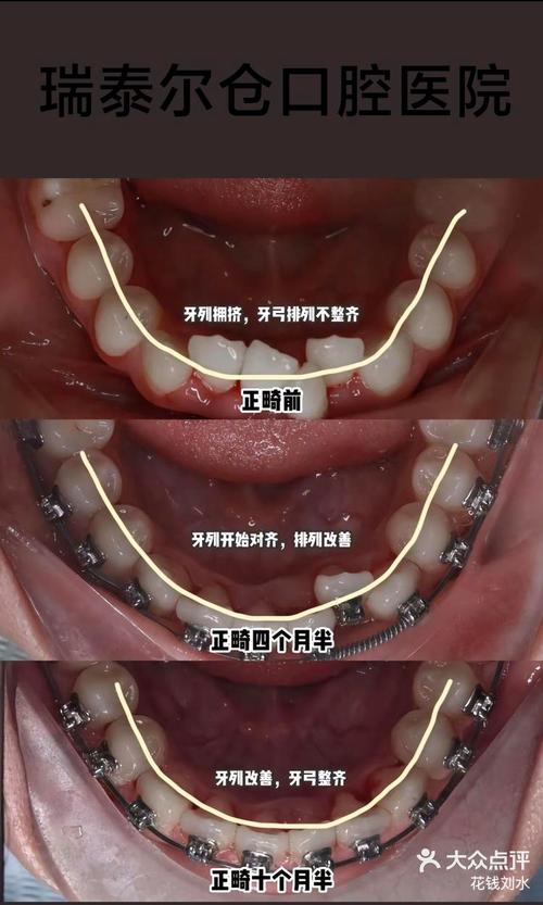 正畸过程中露龈笑-图1 正畸过程中露龈笑-图1
