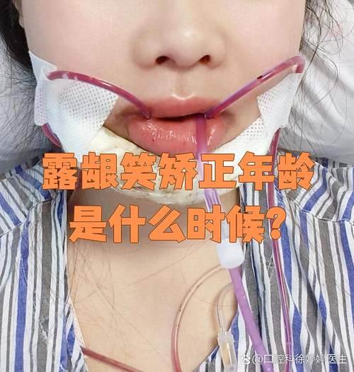 正畸过程中露龈笑-图3 正畸过程中露龈笑-图3