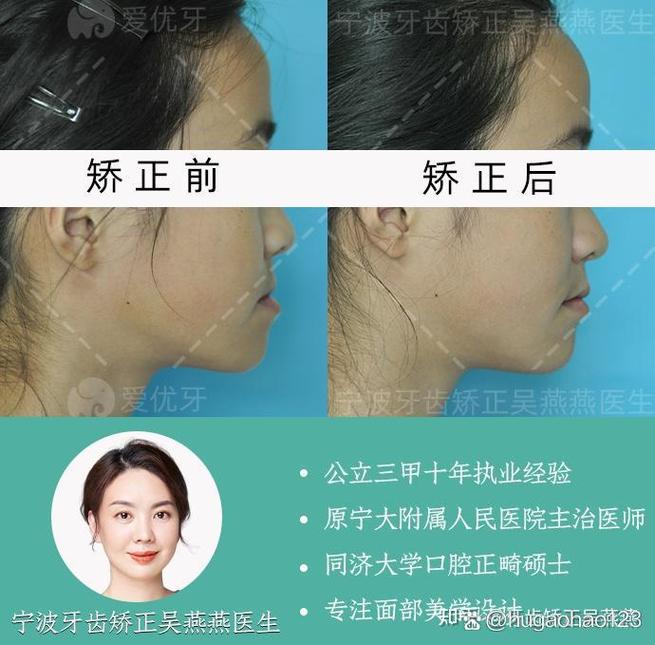 安氏一类正畸真的没用？治疗效果遭质疑？-图1
