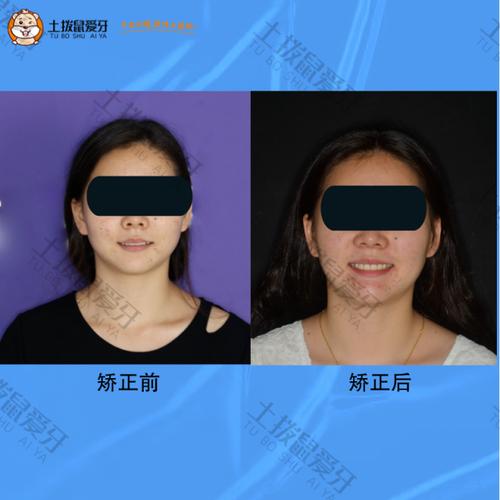 安氏一类正畸真的没用？治疗效果遭质疑？-图2