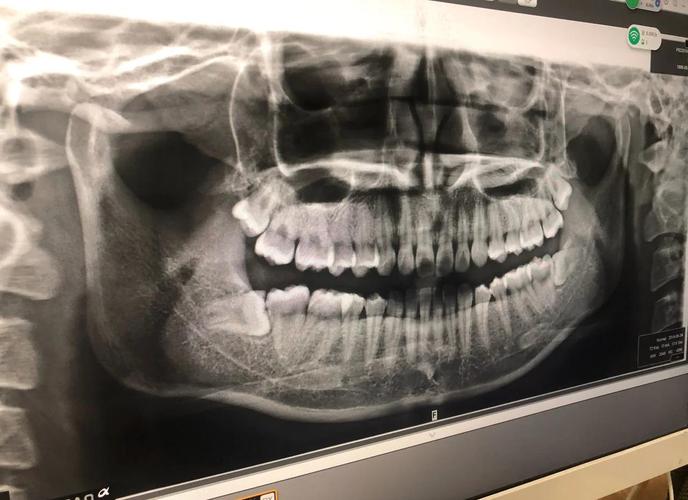 正畸前拔四颗智齿-图3