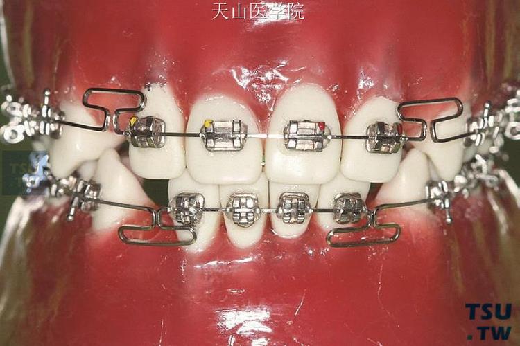 正畸后倾曲弯制6-图2