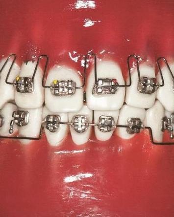 正畸后倾曲弯制6-图3