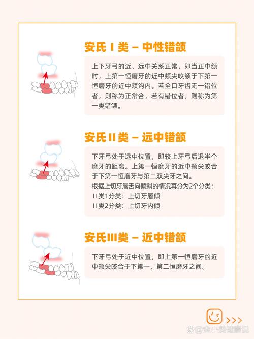 口腔正畸安氏一类是什么？有哪些典型特征与矫正方法？-图1