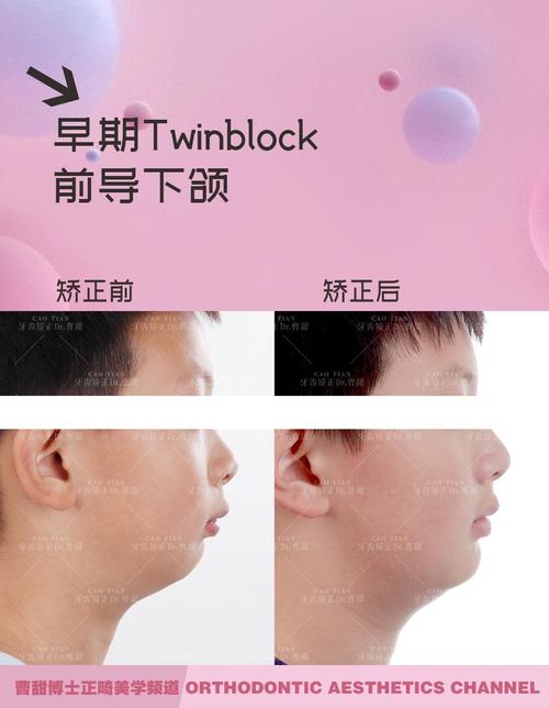 北京大学三院正畸效果怎么样?值得信赖吗?-图3 北京大学三院正畸效果怎么样?值得信赖吗?-图3