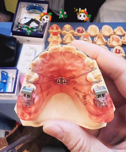 正畸全同步带状弓-图2