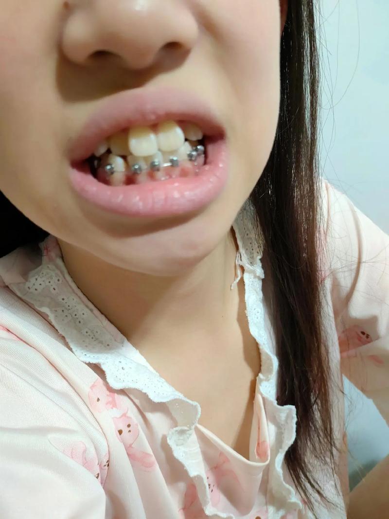 正畸之后牙弓歪了-图2