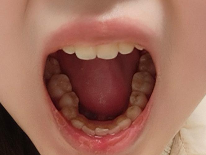 正畸之后牙弓歪了-图1