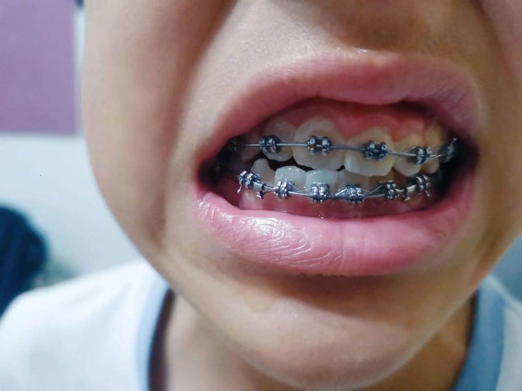 正畸之后牙弓歪了-图3