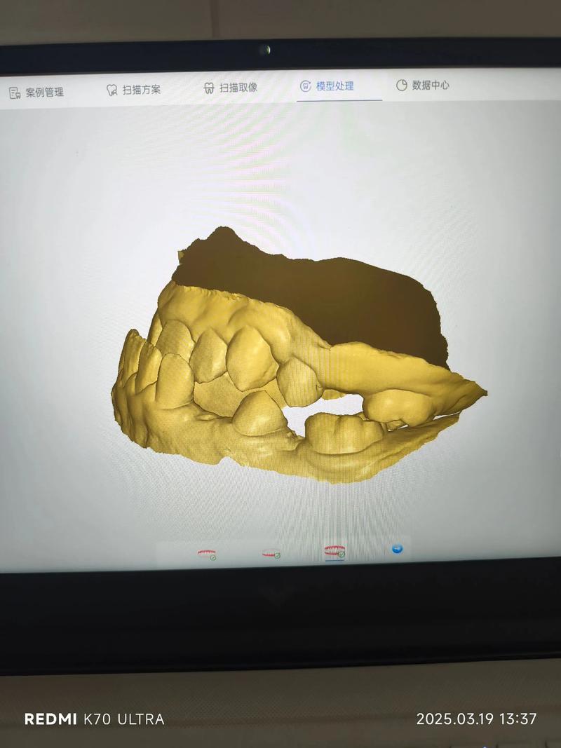 正畸牵引器一般要戴多久？具体时长因人而异吗？-图2