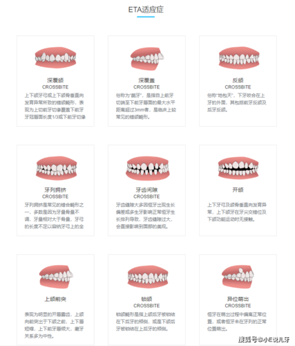 哪些口腔情况属于正畸治疗的适应症？-图2