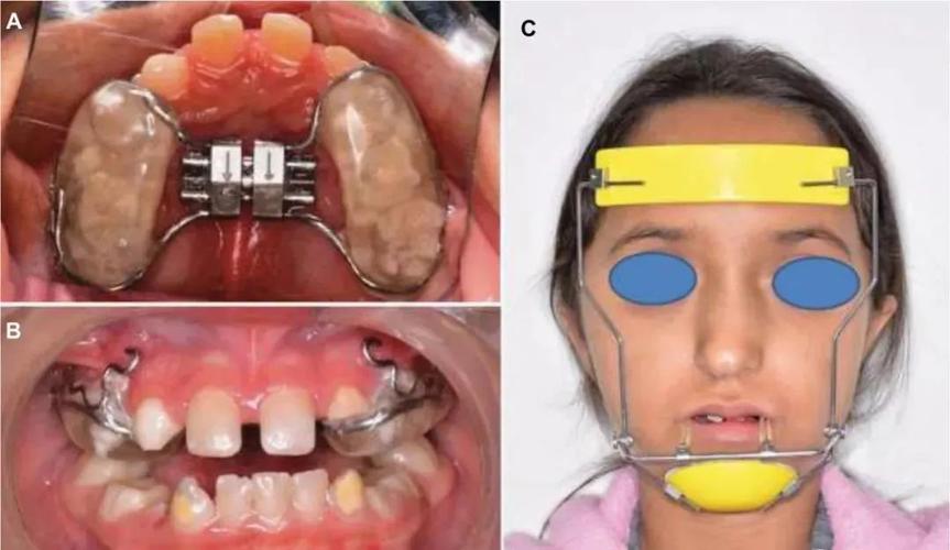 口腔正畸三角牵引-图2
