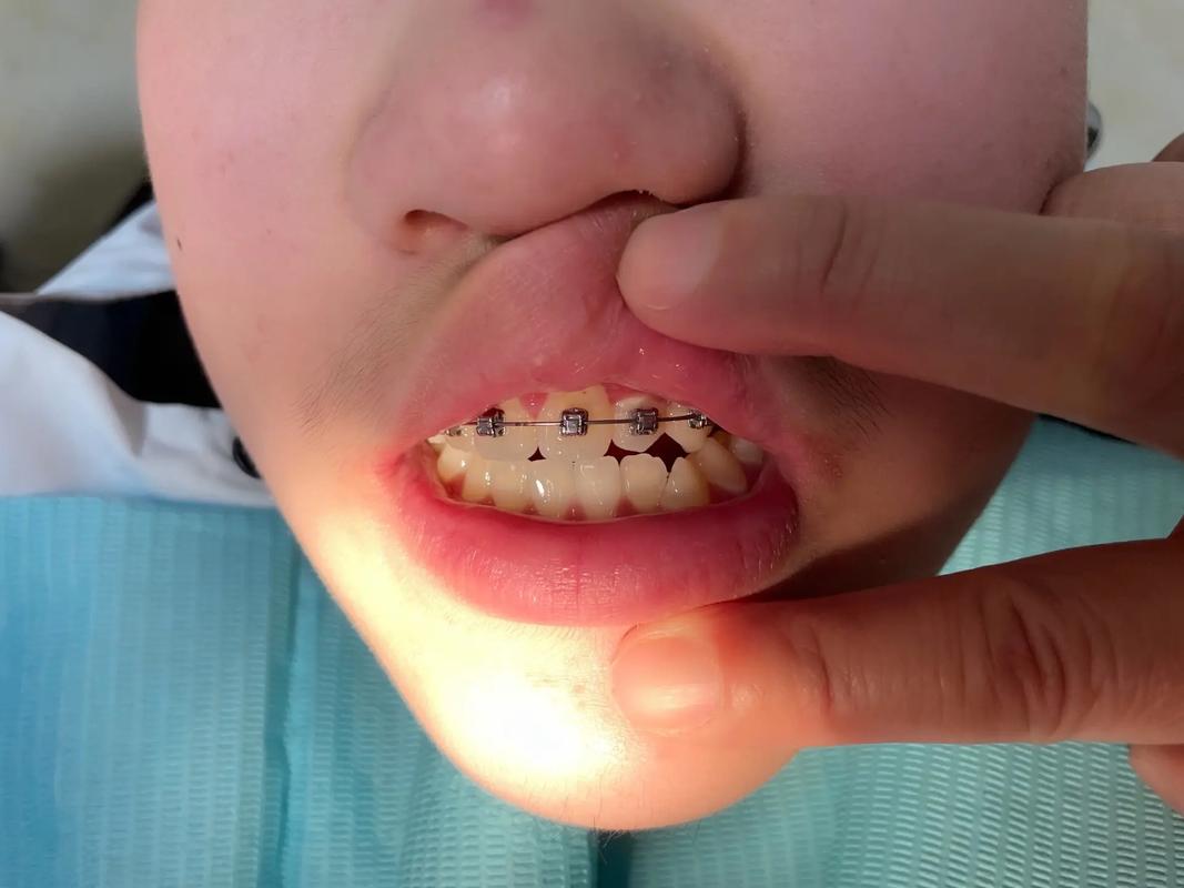 烤瓷牙拔掉做正畸-图2