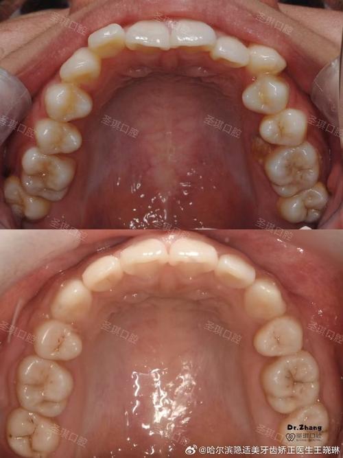 正畸发现埋伏牙，会影响矫正效果吗？-图1