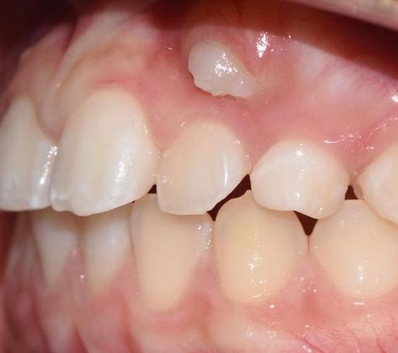 正畸发现埋伏牙，会影响矫正效果吗？-图2