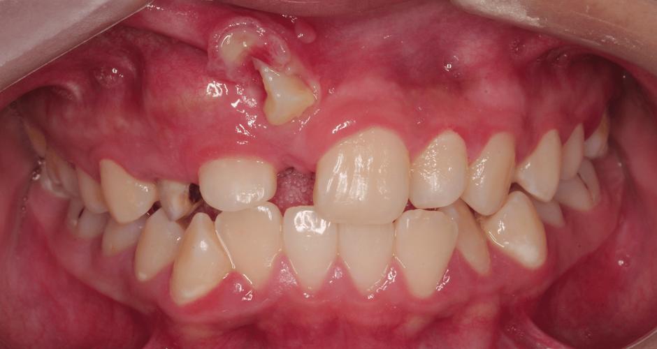 正畸发现埋伏牙，会影响矫正效果吗？-图3