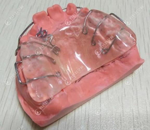 上推簧非拔牙正畸，如何避免拔牙又能有效矫正牙齿？-图1