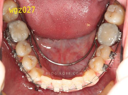 武广增正畸转矩簧-图1