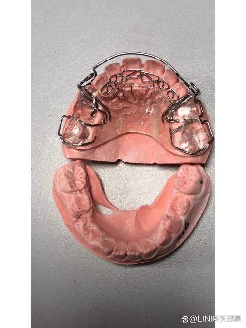 武广增正畸转矩簧-图2