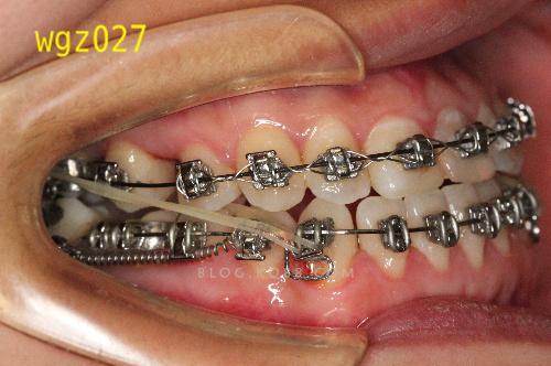 武广增正畸转矩簧-图3