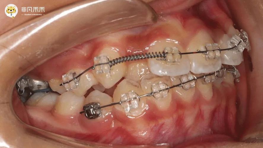正畸中推簧的作用-图1