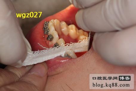正畸邻面去釉步骤-图1
