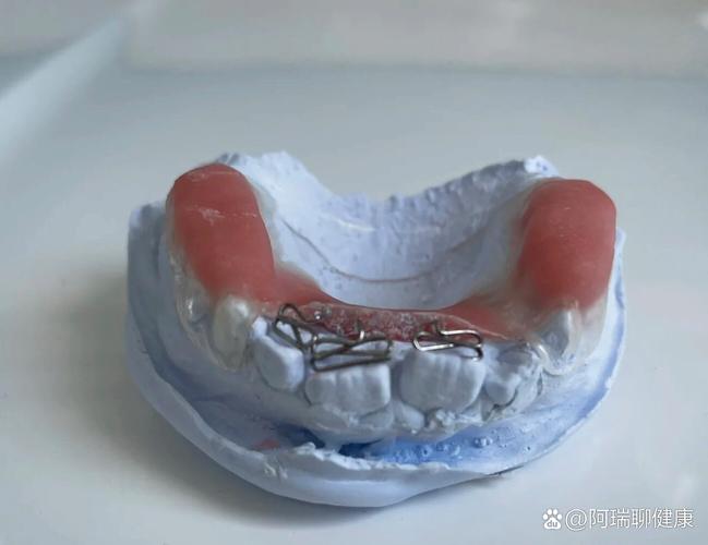 正畸双曲舌簧制作-图1 正畸双曲舌簧制作-图1