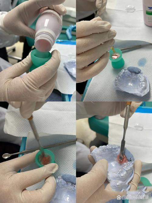 正畸双曲舌簧制作-图2 正畸双曲舌簧制作-图2