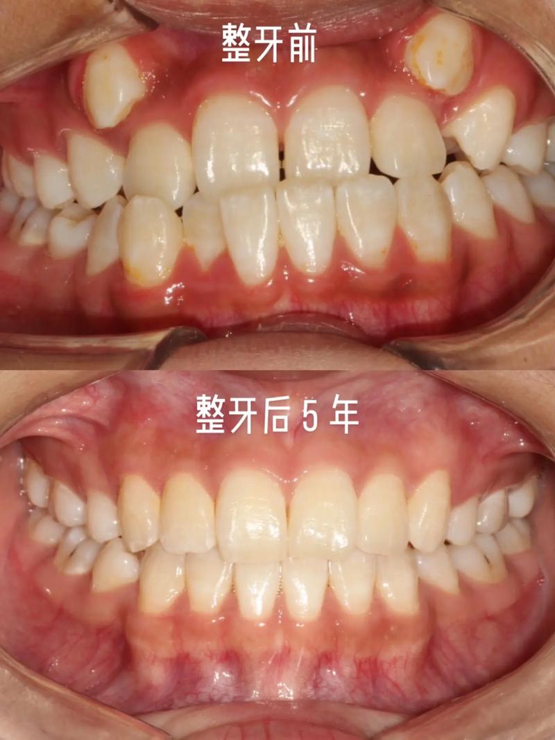 正畸虎牙脸会垮吗-图2