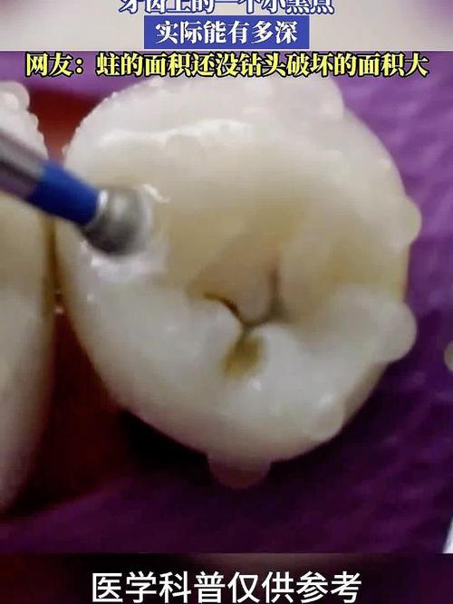 正畸牙齿有小黑点-图2