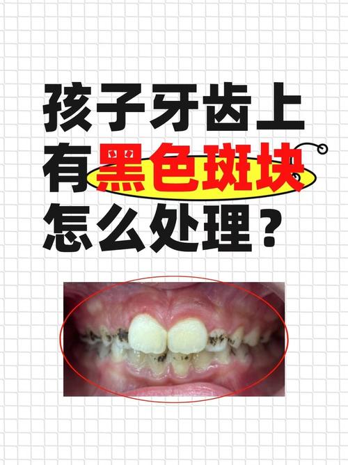 正畸牙齿有小黑点-图1