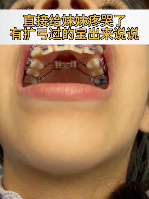 正畸后牙齿还能扩弓矫正吗？-图2