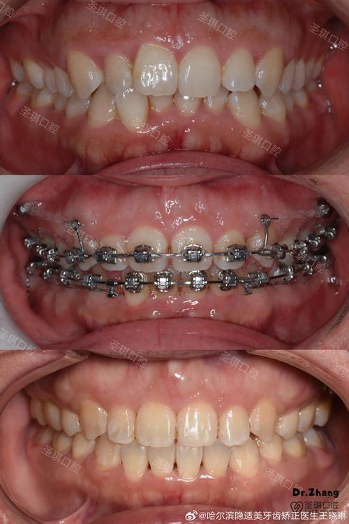 口腔科下颌骨正畸-图1